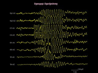 Hypnagogic Hypersynchrony

Fp1-A1

Fp2-A2

C3-A1

C4-A2

O1-A1

O2-A2

T5-A1

T6-A2
50 µV
1 sec

 