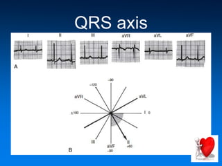 QRS axis
 