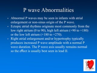 P wave Abnormalities
• Abnormal P waves may be seen in infants with atrial
enlargement or non-sinus origin of the P wave.
• Ectopic atrial rhythms originate most commonly from the
low right atrium (0 to 90), high left atrium (+90 to +180)
or the low left atrium (+180 to +270).
• Right atrial enlargement and/or hypertrophy typically
produces increased P wave amplitude with a normal P
wave duration. The P wave axis usually remains normal
so the effect is usually best seen in lead II.
 