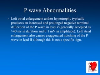 P wave Abnormalities
• Left atrial enlargement and/or hypertrophy typically
produces an increased and prolonged negative terminal
deflection of the P wave in lead V1 (generally accepted as
>40 ms in duration and 0·1 mV in amplitude). Left atrial
enlargement also causes exaggerated notching of the P
wave in lead II although this is not a specific sign.
 