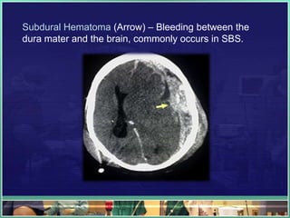 Subdural Hematoma (Arrow) – Bleeding between the
dura mater and the brain, commonly occurs in SBS.
 