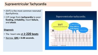 Supraventricular Tachycardia
• (SVT) is the most common neonatal
dysrhythmia.
• C/P range from tachycardia to poor
feeding, irritability, heart failure,
and shock.
Diagnosis
• The heart rate at ≥ 220 beats
• Narrow QRS < 0.08 seconds.
 