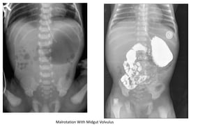 Malrotation With Midgut Volvulus
 