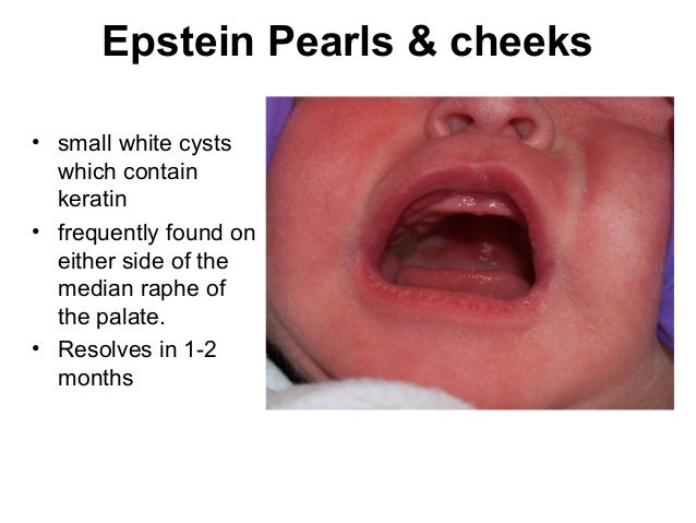 Epstein S Pearls Palatal And Gingival Cysts Of The Newborn ATYAV Epstein S Pearls Palatal And Gingival Cysts Of The Newborn ATYAV