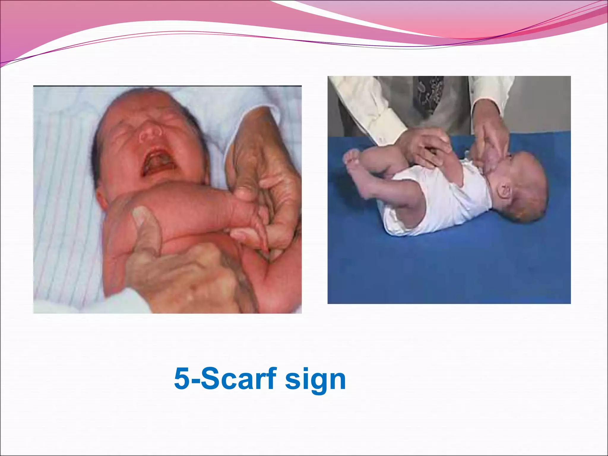 Neonatal Gestational Age Assessment.ppt