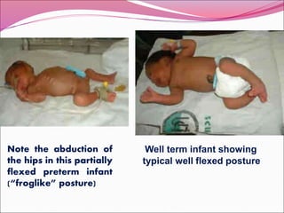 Neonatal Gestational Age Assessment.ppt