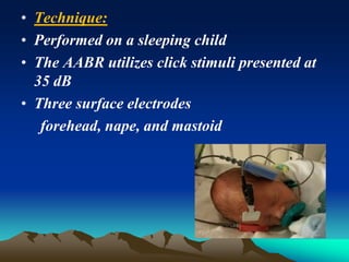 • Technique:
• Performed on a sleeping child
• The AABR utilizes click stimuli presented at
35 dB
• Three surface electrodes
forehead, nape, and mastoid
 