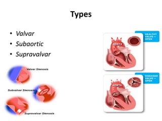 Subaortic Ridge Types Neonatal heart diseases | PPTX