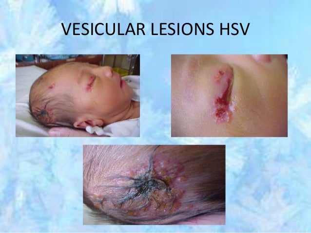 hsv presentation in neonates