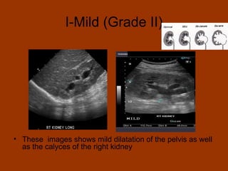 I-Mild (Grade II)




• These images shows mild dilatation of the pelvis as well
  as the calyces of the right kidney
 