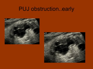 PUJ obstruction..early
 