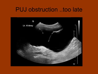 PUJ obstruction ..too late
 
