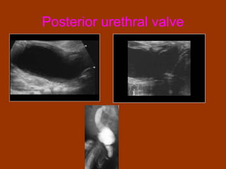 Posterior urethral valve
 