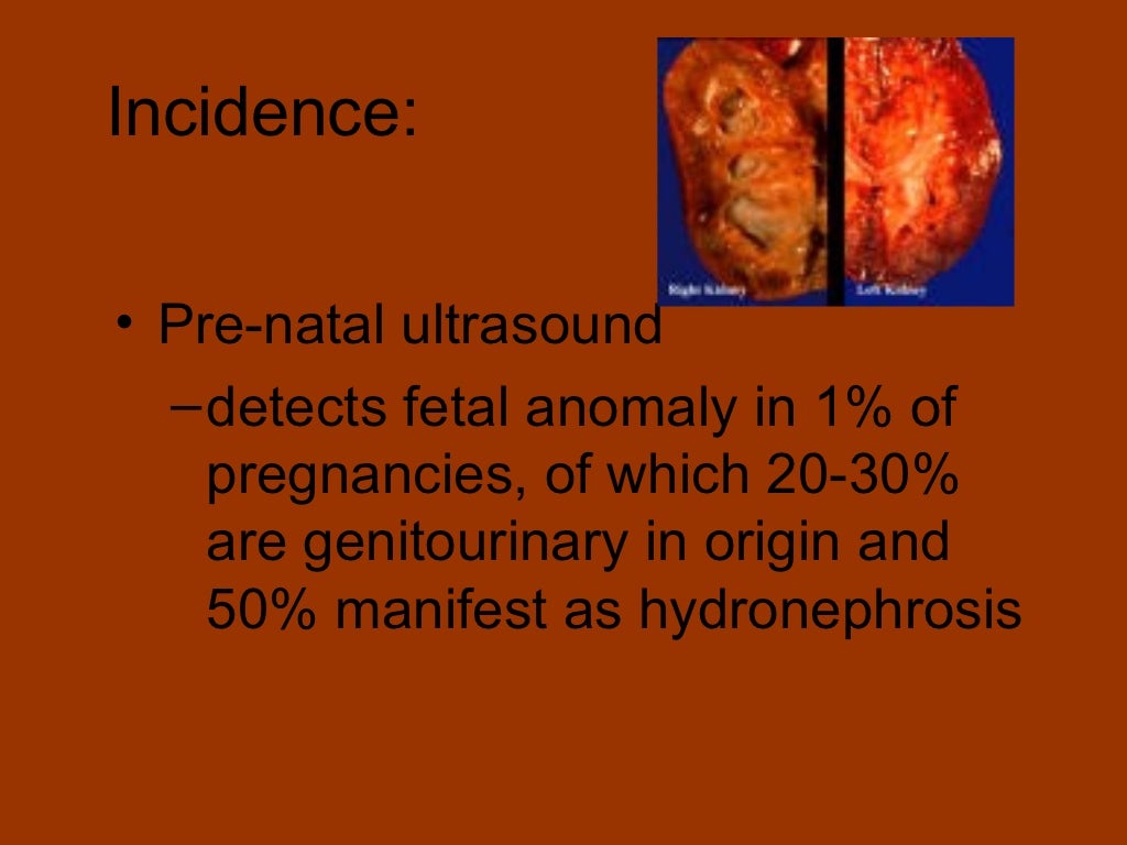 Neonatal hydronephrosis