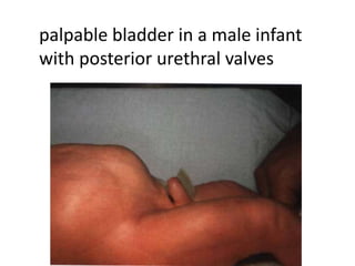 palpable bladder in a male infant
with posterior urethral valves
 