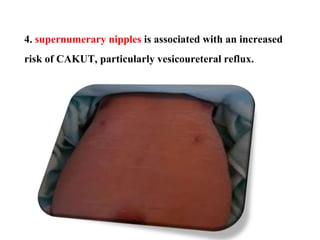 4. supernumerary nipples is associated with an increased
risk of CAKUT, particularly vesicoureteral reflux.
 