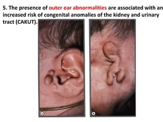 5. The presence of outer ear abnormalities are associated with an
increased risk of congenital anomalies of the kidney and urinary
tract (CAKUT).
 