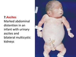 7.Ascites
Marked abdominal
distention in an
infant with urinary
ascites and
bilateral multicystic
kidneys
 