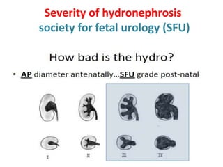 Severity of hydronephrosis
society for fetal urology (SFU(
 