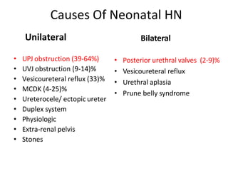 Unilateral
• UPJ obstruction (39-64%)
• UVJ obstruction (9-14)%
• Vesicoureteral reflux (33)%
• MCDK (4-25)%
• Ureterocele/ ectopic ureter
• Duplex system
• Physiologic
• Extra-renal pelvis
• Stones
Bilateral
• Posterior urethral valves (2-9)%
• Vesicoureteral reflux
• Urethral aplasia
• Prune belly syndrome
Causes Of Neonatal HN
 