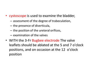 • cystoscope is used to examine the bladder,
– assessment of the degree of trabeculation,
– the presence of diverticula,
– the position of the ureteral orifices,
– examination of the valves
• WITH the 3-Fr Bugbee electrode The valve
leaflets should be ablated at the 5 and 7 o'clock
positions, and on occasion at the 12 o'clock
position
 