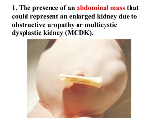 1. The presence of an abdominal mass that
could represent an enlarged kidney due to
obstructive uropathy or multicystic
dysplastic kidney (MCDK).
 