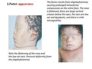 2.Potter appearance
Note the flattening of the nose and
the low-set ears. Pressure deformity from
the oligohydramnios
The facies results from oligohydramnios
causing prolonged intrauterine
compression on the entire face. The nose
is flattened, there are large vertical
creases below the eyes, the ears are low
set and dysplastic, and there is mild
micrognathia.
 