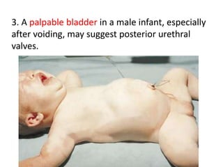 3. A palpable bladder in a male infant, especially
after voiding, may suggest posterior urethral
valves.
 