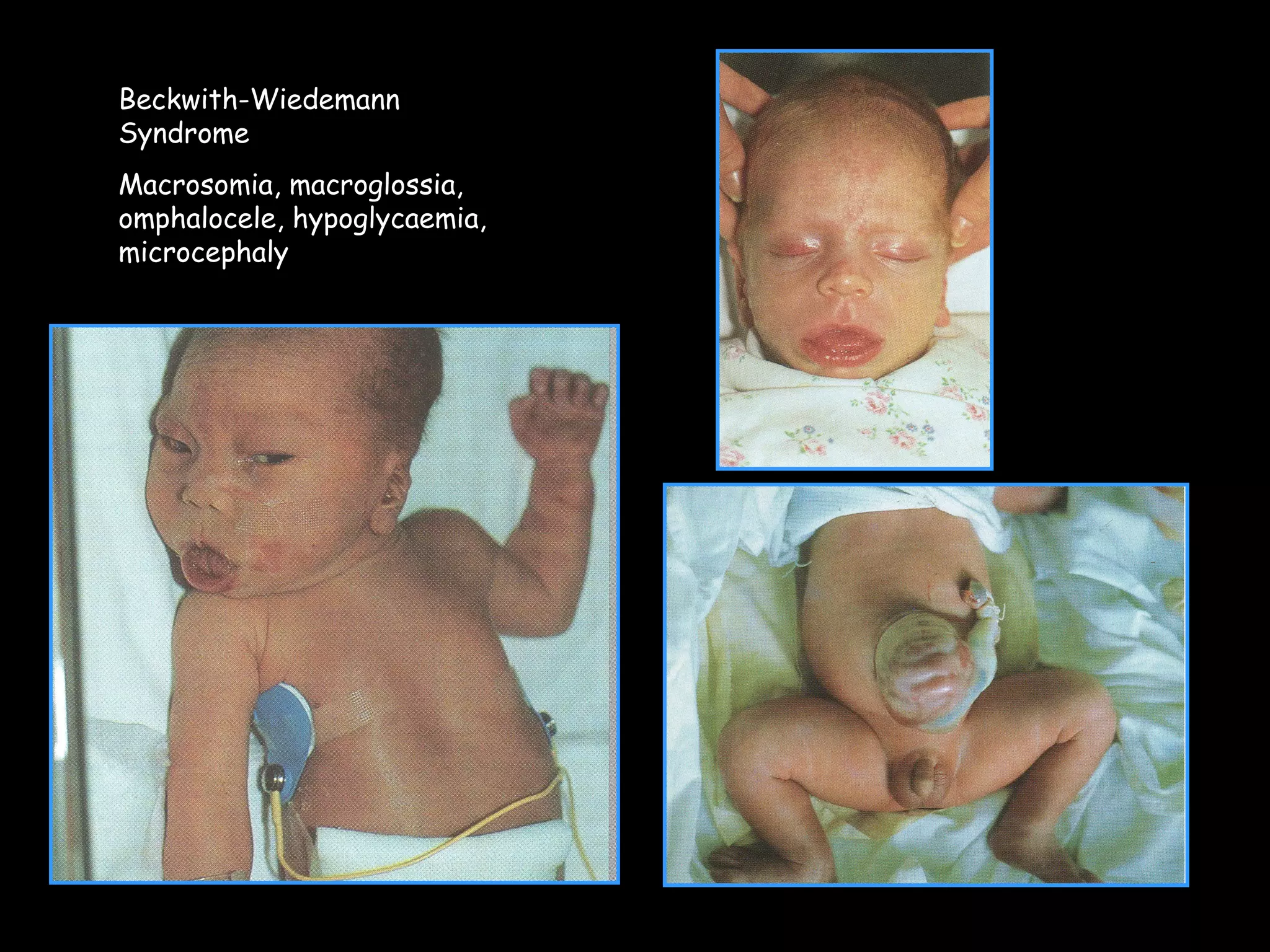Beckwith-Wiedemann
Syndrome
Macrosomia, macroglossia,
omphalocele, hypoglycaemia,
microcephaly
 