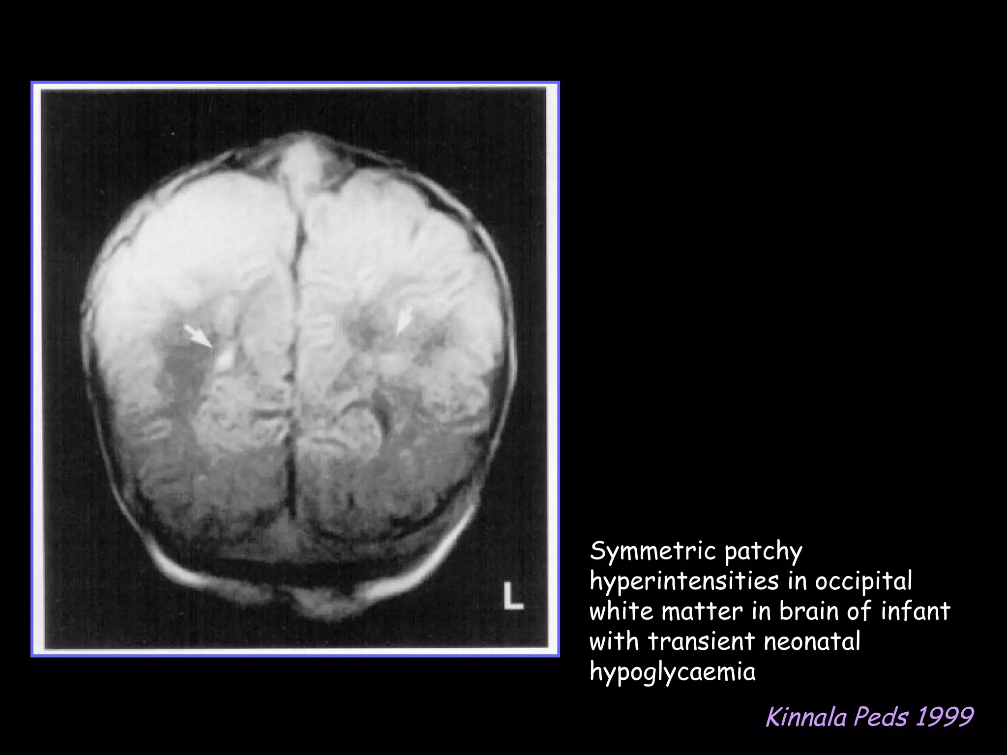 Symmetric patchy
hyperintensities in occipital
white matter in brain of infant
with transient neonatal
hypoglycaemia
              Kinnala Peds 1999
 