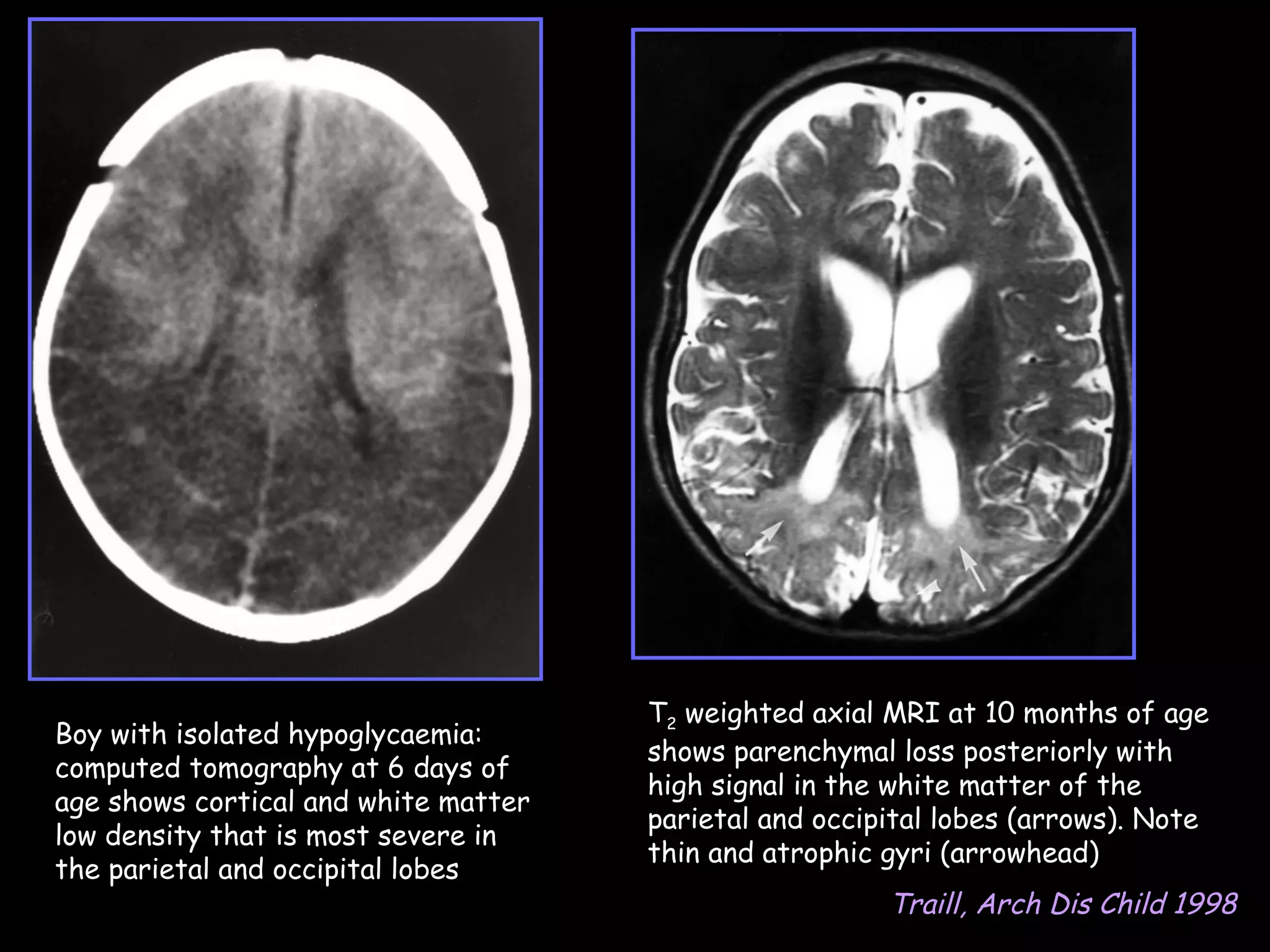 T2 weighted axial MRI at 10 months of age
Boy with isolated hypoglycaemia:
                                      shows parenchymal loss posteriorly with
computed tomography at 6 days of
                                      high signal in the white matter of the
age shows cortical and white matter
                                      parietal and occipital lobes (arrows). Note
low density that is most severe in
                                      thin and atrophic gyri (arrowhead)
the parietal and occipital lobes
                                                        Traill, Arch Dis Child 1998
 