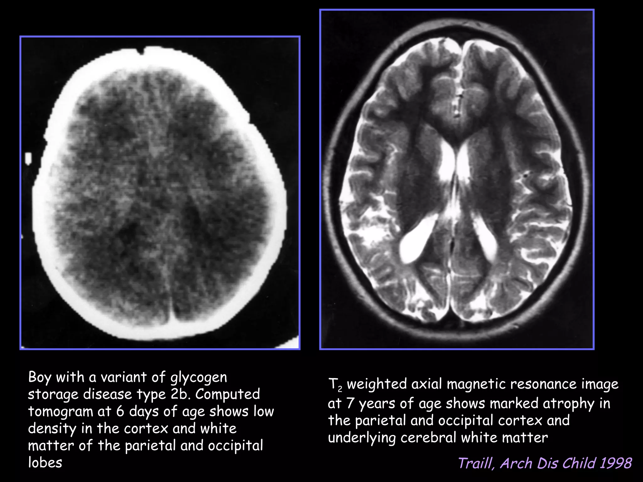 Boy with a variant of glycogen         T2 weighted axial magnetic resonance image
storage disease type 2b. Computed
                                       at 7 years of age shows marked atrophy in
tomogram at 6 days of age shows low
                                       the parietal and occipital cortex and
density in the cortex and white
                                       underlying cerebral white matter
matter of the parietal and occipital
lobes                                                    Traill, Arch Dis Child 1998
 