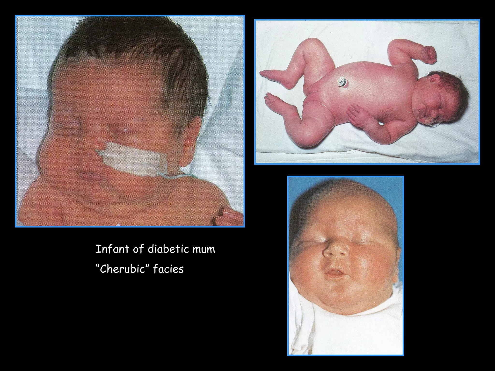 Infant of diabetic mum
“Cherubic” facies
 