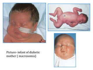 Infant of diabetic mum
“Cherubic” facies
Picture- infant of diabetic
mother ( macrosomia)
 