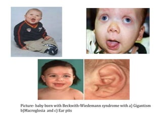 Picture- baby born with Beckwith-Wiedemann syndrome with a) Gigantism
b)Macroglosia and c) Ear pits
 