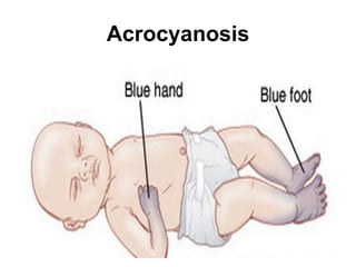Acrocyanosis
 
