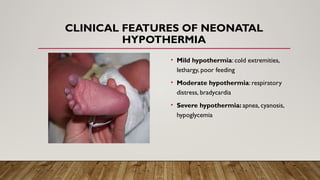 CLINICAL FEATURES OF NEONATAL
HYPOTHERMIA
• Mild hypothermia: cold extremities,
lethargy, poor feeding
• Moderate hypothermia: respiratory
distress, bradycardia
• Severe hypothermia: apnea, cyanosis,
hypoglycemia
 