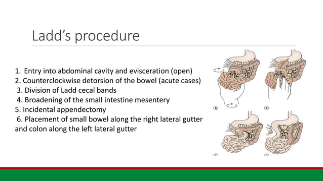 Neonatal Intestinal Obstruction Etiology Diagnosis And Management pptx Neonatal Intestinal Obstruction Etiology Diagnosis And Management pptx