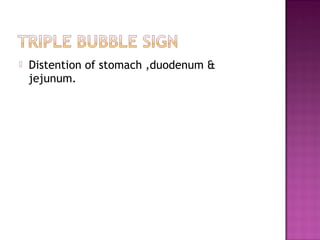  Distention of stomach ,duodenum &
jejunum.
 