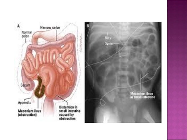 Neonatal Intestinal Obstruction neonatal-intestinal-obstruction