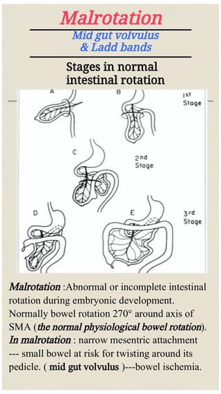 Normal Ob Gut Rotation Neonatal intestinal obstruction | PDF