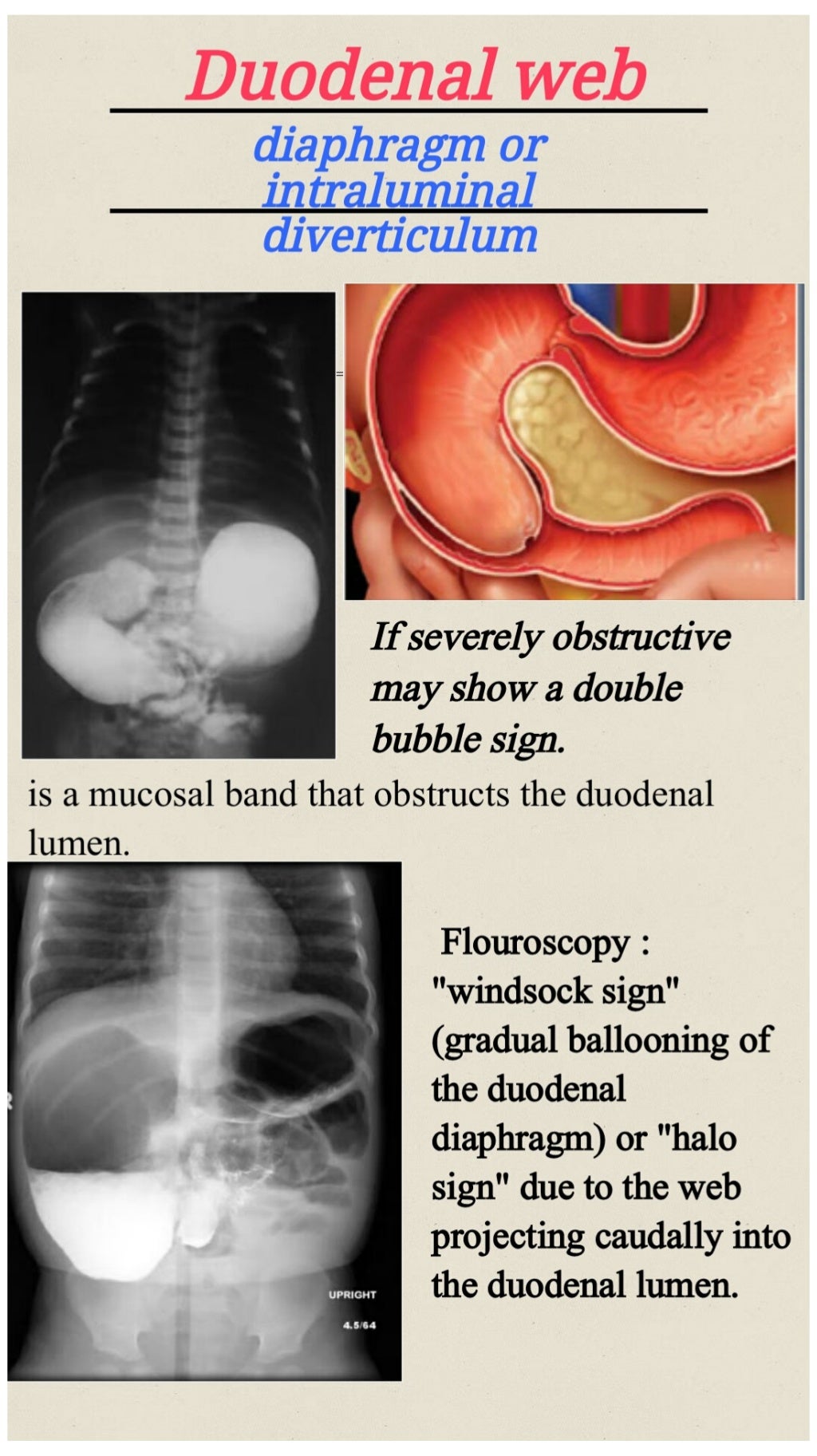 Neonatal intestinal obstruction