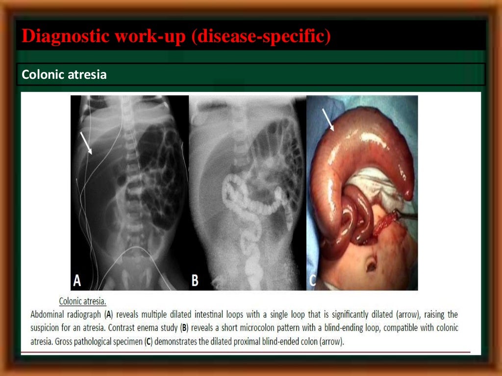 Neonatal intestinal obstruction