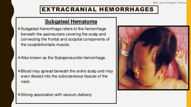 neonatal intracranial hemorrhage by dr sonali mhatre subgaleal hemorrhage