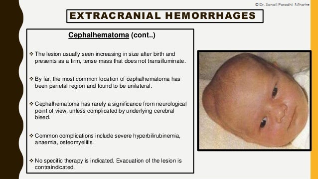 neonatal intracranial hemorrhage by dr sonali mhatre subgaleal hemorrhage
