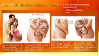 • It is an isoimmune hemolysis
associated with
– Rh incompatibility or
– ABO
An Rh+ man and an
Rh – woman coul
dhave an Rh + baby`
1st Pregnancy: At birth some of
the Rh+ blood of fetus may
enter mother’s circulation``
After delivery: The mother
forms anti-Rh antibodies
over next few months
2nd pregnancy with Rh+
fetus: Anti-Rh antibodies
pass into the fetus causing
its blood cells to lyse
 