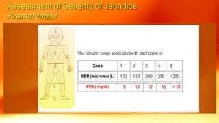 SRB ( mg/dL) 5 10 12 15 > 15
 