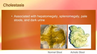 • Associated with hepatomegaly, splenomegaly, pale
stools, and dark urine
Normal Stool Acholic Stool
 