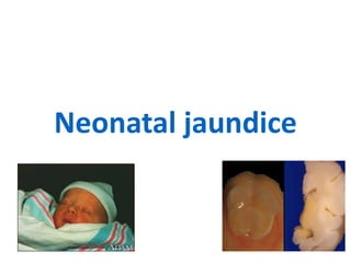 Neonatal jaundice
 