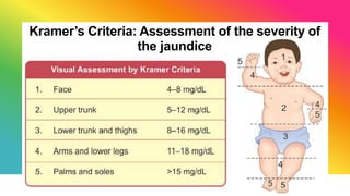 Kramer Test NEONATAL JAUNDICE.pptx